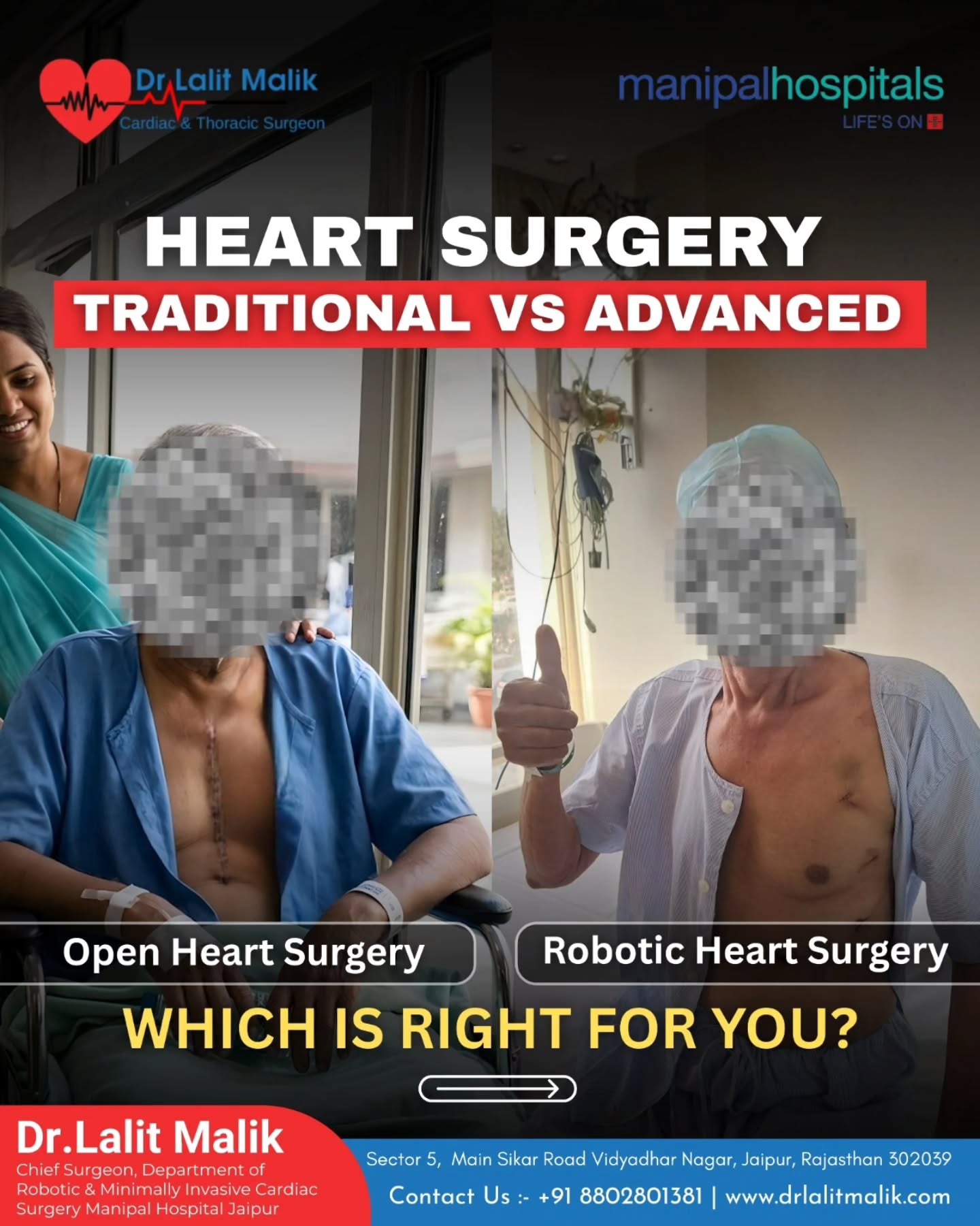 𝐓𝐡𝐞 𝐅𝐮𝐭𝐮𝐫𝐞 𝐨𝐟 𝐇𝐞𝐚𝐫𝐭 𝐂𝐚𝐫𝐞
𝐂𝐡𝐨𝐨𝐬𝐞 𝐈𝐧𝐧𝐨𝐯𝐚𝐭𝐢𝐨𝐧. 𝐂𝐡𝐨𝐨𝐬𝐞 𝐏𝐫𝐞𝐜𝐢𝐬𝐢𝐨𝐧. 𝐂𝐡𝐨𝐨𝐬𝐞 𝐅𝐚𝐬𝐭𝐞𝐫 𝐑𝐞𝐜𝐨𝐯𝐞𝐫𝐲.
Are you or a loved one facing heart surgery? Understanding your options is the first step toward a 𝐡𝐞𝐚𝐥𝐭𝐡𝐢𝐞𝐫 𝐟𝐮𝐭𝐮𝐫𝐞.
𝐃𝐫. 𝐋𝐚𝐥𝐢𝐭 𝐌𝐚𝐥𝐢𝐤, 𝐂𝐡𝐢𝐞𝐟 𝐒𝐮𝐫𝐠𝐞𝐨𝐧 𝐚𝐭 𝐌𝐚𝐧𝐢𝐩𝐚𝐥 𝐇𝐨𝐬𝐩𝐢𝐭𝐚𝐥 𝐉𝐚𝐢𝐩𝐮𝐫, explains the key differences between 𝐭𝐫𝐚𝐝𝐢𝐭𝐢𝐨𝐧𝐚𝐥 𝐨𝐩𝐞𝐧-𝐡𝐞𝐚𝐫𝐭 𝐬𝐮𝐫𝐠𝐞𝐫𝐲 and 𝐦𝐨𝐝𝐞𝐫𝐧 𝐫𝐨𝐛𝐨𝐭𝐢𝐜-𝐚𝐬𝐬𝐢𝐬𝐭𝐞𝐝 𝐬𝐮𝐫𝐠𝐞𝐫𝐲.
While traditional methods are well-established, robotic surgery offers several advanced benefits:
🔹 𝐒𝐦𝐚𝐥𝐥 𝐊𝐞𝐲𝐡𝐨𝐥𝐞 𝐈𝐧𝐜𝐢𝐬𝐢𝐨𝐧𝐬:- No large chest incisions or bone cutting required
🔹 𝐅𝐚𝐬𝐭𝐞𝐫 𝐑𝐞𝐜𝐨𝐯𝐞𝐫𝐲:- Return to your daily routine within 2–3 weeks, compared to 8–12 weeks with traditional surgery
🔹 𝐒𝐮𝐩𝐞𝐫𝐢𝐨𝐫 𝐏𝐫𝐞𝐜𝐢𝐬𝐢𝐨𝐧:- Enhanced accuracy leads to less blood loss and a lower risk of infection
🔹 𝐌𝐢𝐧𝐢𝐦𝐚𝐥 𝐒𝐜𝐚𝐫𝐫𝐢𝐧𝐠:- Better healing with minimal visible marks
Your heart deserves the most advanced care available.
Do not settle for conventional methods when modern innovation is within reach.
(Dr Lalit Malik Cardiac Surgeon, Robotic Heart Surgery Jaipur, Best Heart Surgeon in Rajasthan, Manipal Hospital Jaipur Cardiology, Minimally Invasive Cardiac Surgery, Open Heart vs Robotic Surgery, Robotic Valve Replacement, Heart Bypass Surgery Jaipur, Keyhole Heart Surgery, Cardiac Surgeon Second Opinion, Robotic Thoracic Surgeon, Recovery Time Heart Surgery, Minimal Scarring Surgery, Advanced Cardiac Care India, Manipal Hospital Cardiac Department, Dr Lalit Malik Manipal Hospital, Heart Surgery Without Bone Cutting, Best Robotic Heart Surgery Doctor)
📍 𝐒𝐞𝐜𝐭𝐨𝐫 𝟓, 𝐌𝐚𝐢𝐧 𝐒𝐢𝐤𝐚𝐫 𝐑𝐨𝐚𝐝, 𝐕𝐢𝐝𝐡𝐲𝐚𝐝𝐡𝐚𝐫 𝐍𝐚𝐠𝐚𝐫, 𝐉𝐚𝐢𝐩𝐮𝐫
📞 +𝟗𝟏 𝟖𝟖𝟎𝟐𝟖𝟎𝟏𝟑𝟖𝟏
🌐 𝐰𝐰𝐰.𝐝𝐫𝐥𝐚𝐥𝐢𝐭𝐦𝐚𝐥𝐢𝐤.𝐜𝐨𝐦
#RoboticHeartSurgery #CardiacCare #DrLalitMalik #ManipalHospitalJaipur #HeartHealthMatters